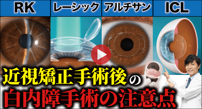 近視矯正手術後の白内障手術の注意点